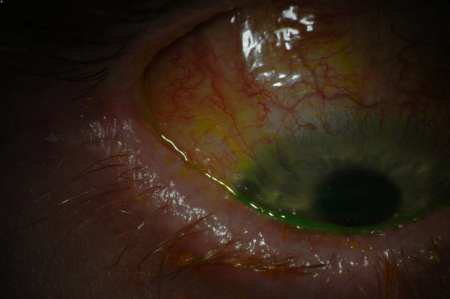Right Eye - 24 year old male who suffered Toxic Epidermal Necrolysis Syndrome with severe Ocular involvement. Photo was taken 2 years after the initial TEN reaction (2)